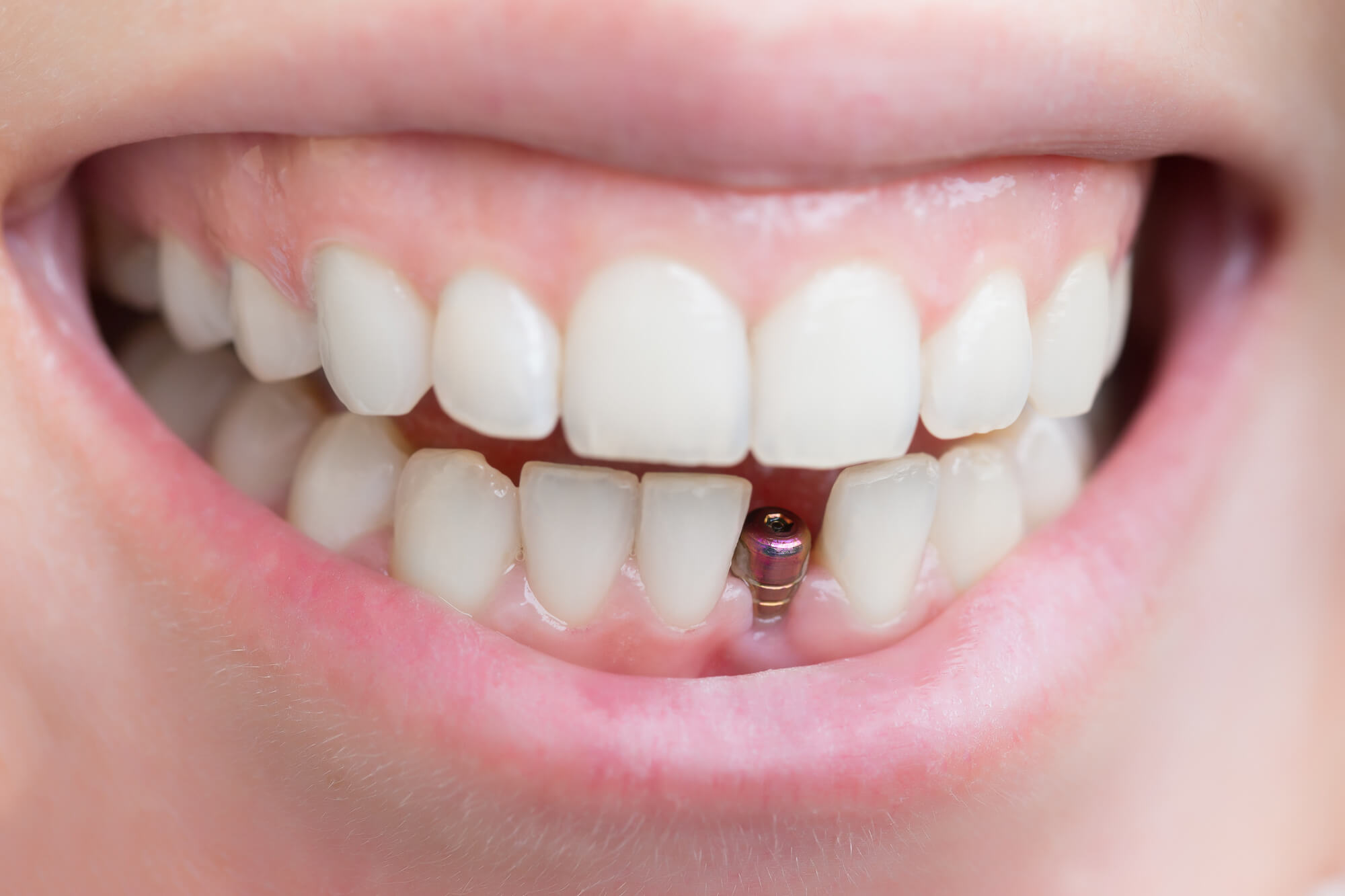 Dental Implants: Do You Need One?